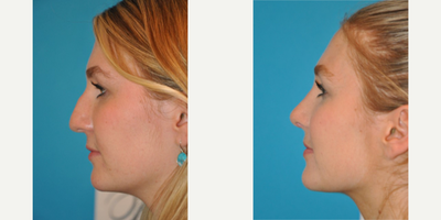 Case 3940 - Woman treated with Rhinoplasty
