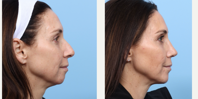 Case 3942 - 45-54 year old woman treated with Rhinoplasty, Chin Implant