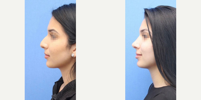 Case 3944 - Woman treated with Rhinoplasty