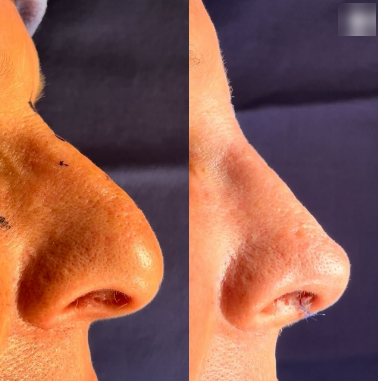 Case 3945 - Man treated with Rhinoplasty
