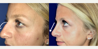 Case 3946 - Woman treated with Rhinoplasty