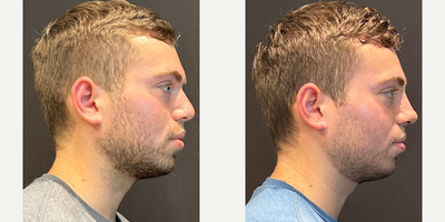 Case 3947 - Man treated with Rhinoplasty