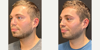 Case 3948 - Man treated with Rhinoplasty