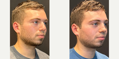 Case 3949 - Man treated with Rhinoplasty