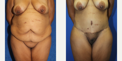 Case 395 - 25-34 year old woman treated with Tummy Tuck