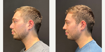 Case 3950 - Man treated with Rhinoplasty