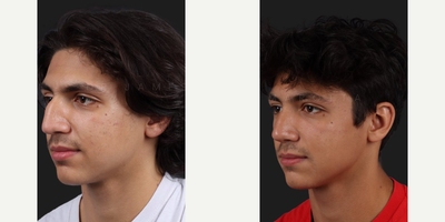 Case 3953 - Man treated with Rhinoplasty