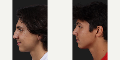 Case 3954 - Woman treated with Rhinoplasty