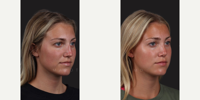 Case 3955 - Woman treated with Rhinoplasty, Septoplasty