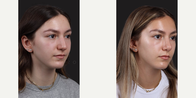 Case 3958 - Woman treated with Rhinoplasty, Septoplasty