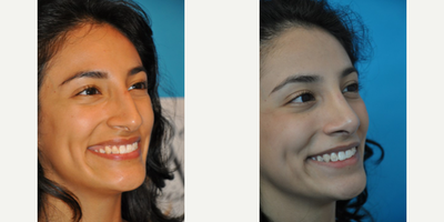 Case 3959 - Woman treated with Rhinoplasty