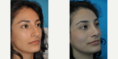 Case 3960 - Woman treated with Rhinoplasty