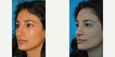 Case 3961 - Woman treated with Rhinoplasty