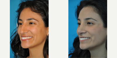 Case 3962 - Woman treated with Rhinoplasty