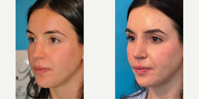 Case 3963 - Woman treated with Rhinoplasty