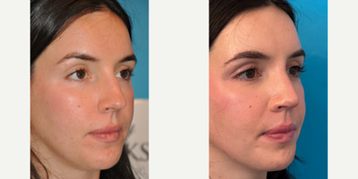 Case 3964 - Woman treated with Rhinoplasty