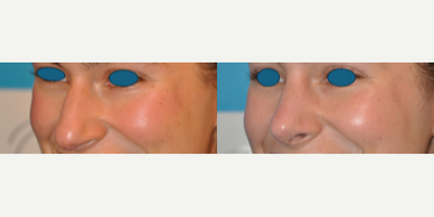 Case 3965 - Woman treated with Rhinoplasty