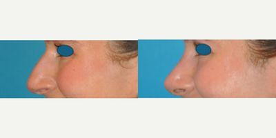 Case 3966 - Woman treated with Rhinoplasty
