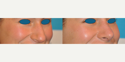 Case 3967 - Woman treated with Rhinoplasty