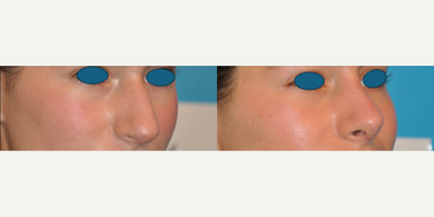 Case 3968 - Woman treated with Rhinoplasty