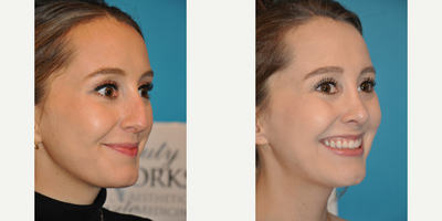 Case 3969 - Woman treated with Rhinoplasty