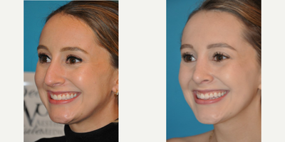 Case 3970 - Woman treated with Rhinoplasty