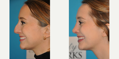 Case 3971 - Woman treated with Rhinoplasty