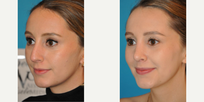 Case 3972 - Woman treated with Rhinoplasty