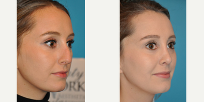 Case 3973 - Woman treated with Rhinoplasty