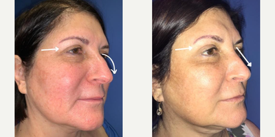 Case 3974 - Woman treated with Eyelid Surgery, Rhinoplasty
