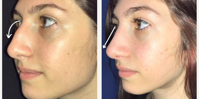 Case 3975 - Woman treated with Rhinoplasty