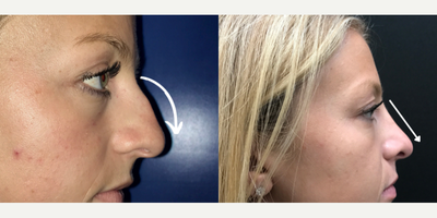Case 3976 - Woman treated with Rhinoplasty