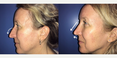 Case 3977 - Woman treated with Rhinoplasty