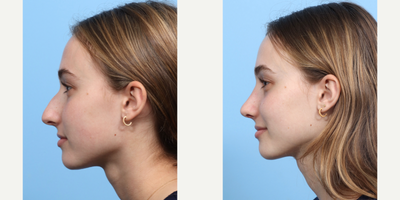 Case 3978 - 17 or under year old woman treated with Rhinoplasty