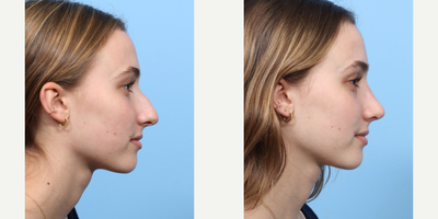 Case 3979 - 17 or under year old woman treated with Rhinoplasty