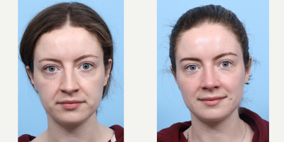Case 3981 - 25-34 year old woman treated with Rhinoplasty