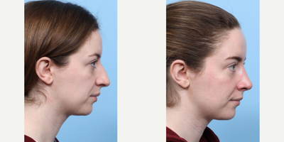 Case 3982 - 25-34 year old woman treated with Rhinoplasty
