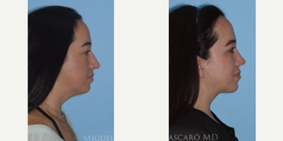 Case 3983 - Woman treated with Rhinoplasty