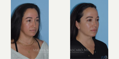 Case 3984 - Woman treated with Rhinoplasty