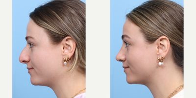 Case 3985 - 18-24 year old woman treated with Rhinoplasty
