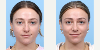 Case 3986 - 18-24 year old woman treated with Rhinoplasty