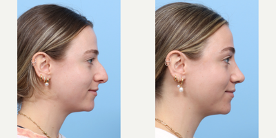 Case 3987 - 18-24 year old woman treated with Rhinoplasty