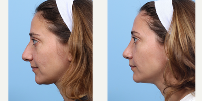 Case 3988 - 35-44 year old woman treated with Rhinoplasty