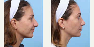 Case 3989 - 35-44 year old woman treated with Rhinoplasty