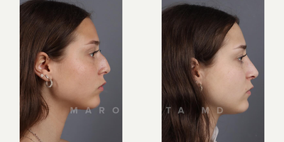 Case 3990 - Woman treated with Rhinoplasty