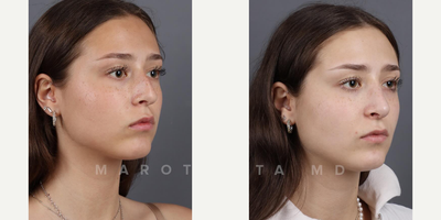 Case 3991 - Woman treated with Rhinoplasty
