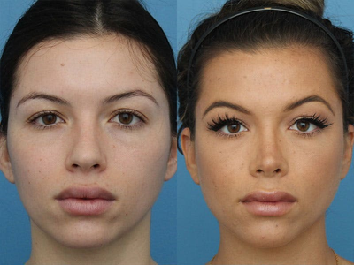 Case 3992 - Woman treated with Rhinoplasty
