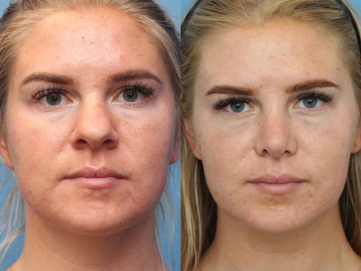 Case 3993 - Woman treated with Rhinoplasty