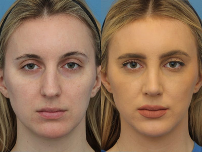 Case 3994 - Woman treated with Rhinoplasty