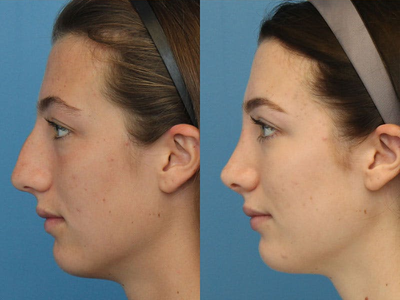 Case 3995 - Woman treated with Rhinoplasty